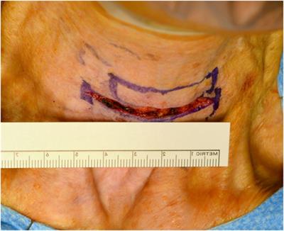 Open Maximal Mucosa-Sparing Functional Total Laryngectomy